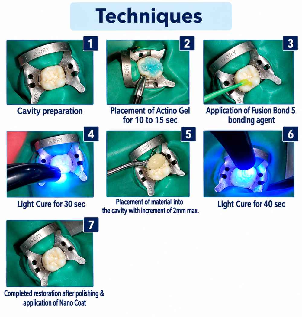Prevest Fusion Universal Composite 7Syr Kit