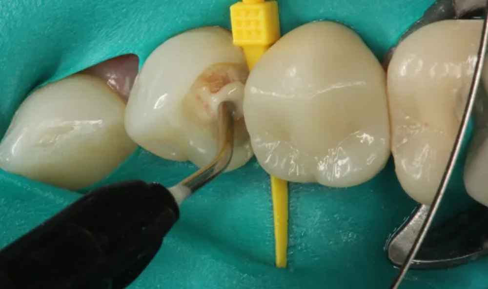 Prevest Denpro ApaCal ART 2g
