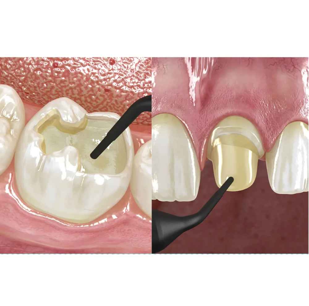 GC Ever X Flow High Strength Posterior Fiber Reinforced Bulk Fill Composite