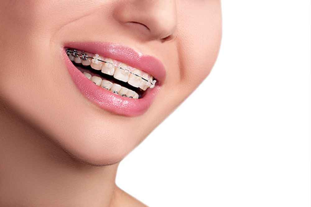 Dental Ceramic Orthodontic Bracket Kit 