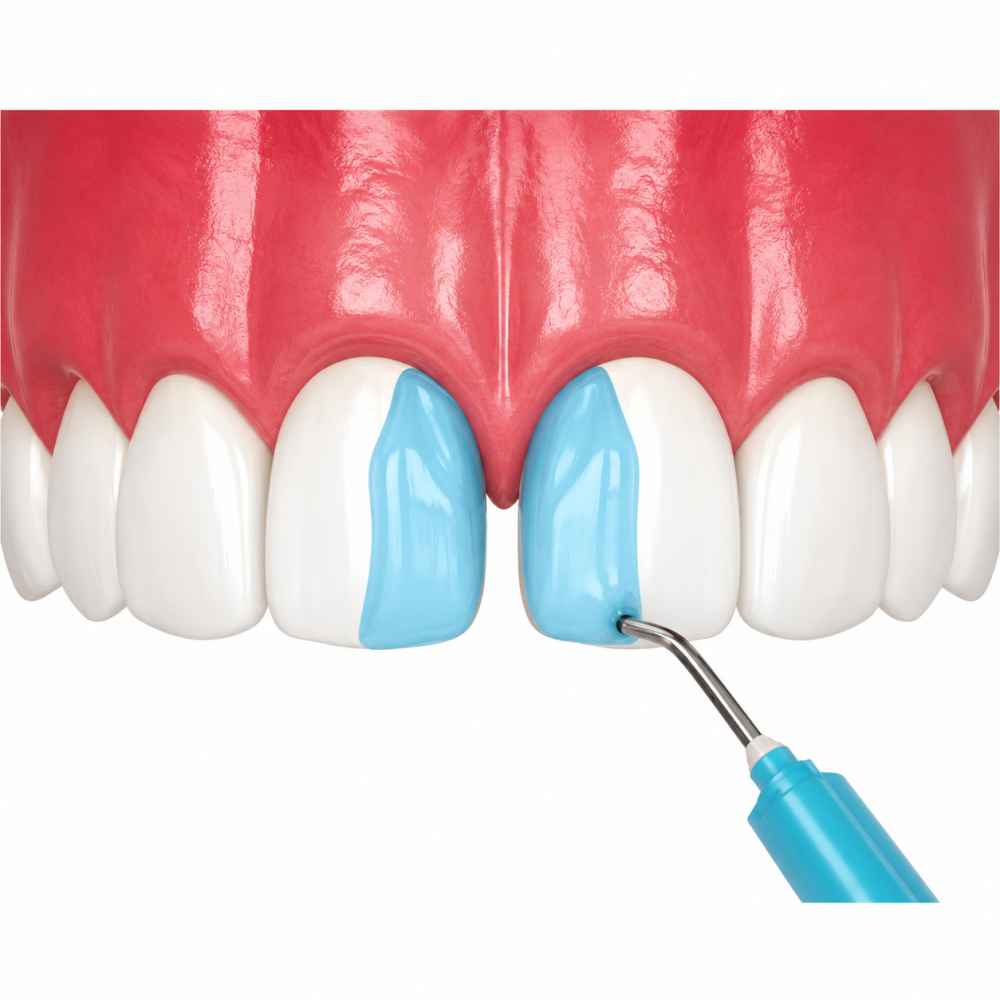 Ivoclar N-Etch Jumbo (30gm+2gm)