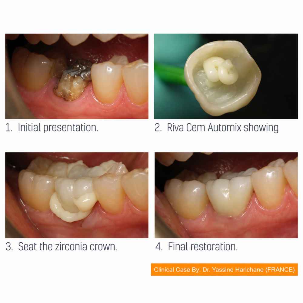 Sdi Dental Riva Cem Automix - Resin-Based Glass Ionomer Cement 2*4 g