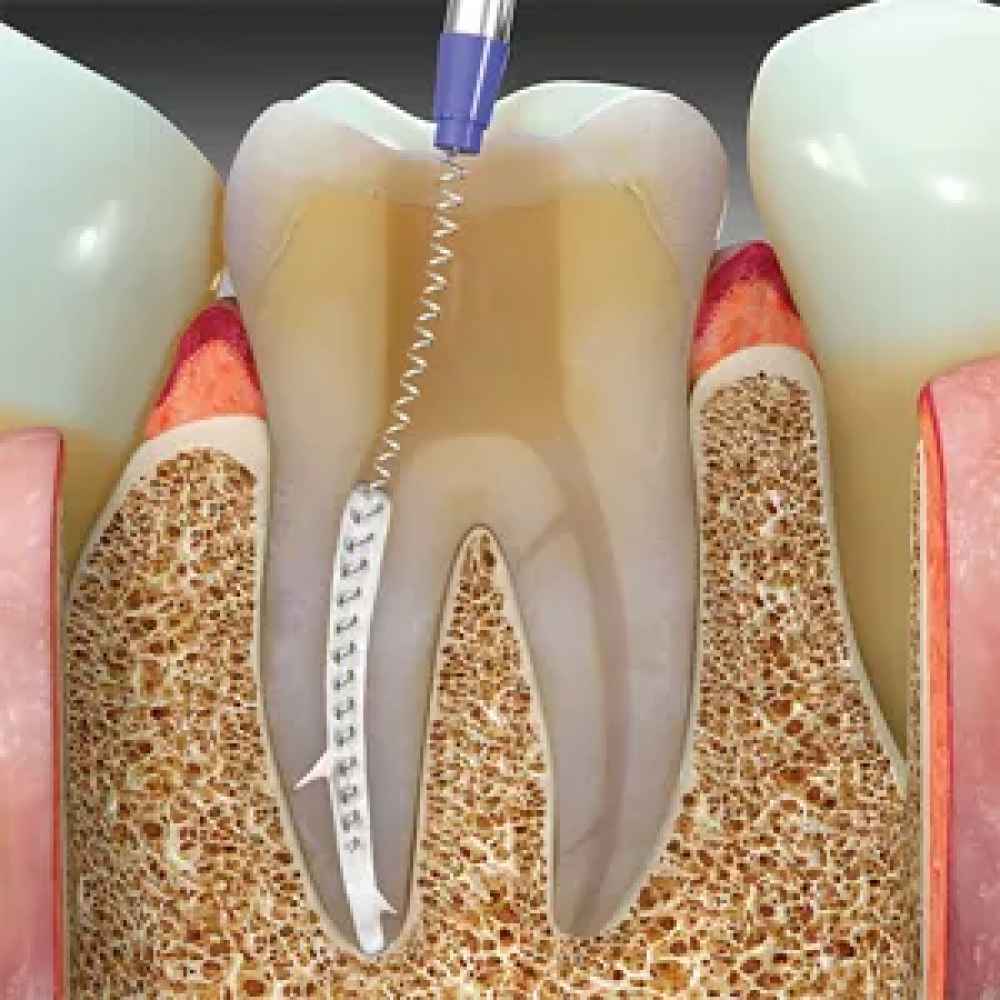 Maarc Sealmax+ MTA based Bio Ceramic root canal sealing material