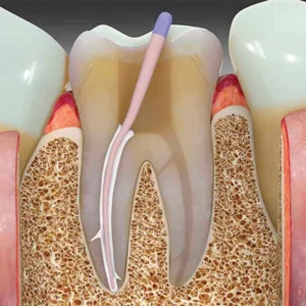 Maarc Sealmax+ MTA based Bio Ceramic root canal sealing material