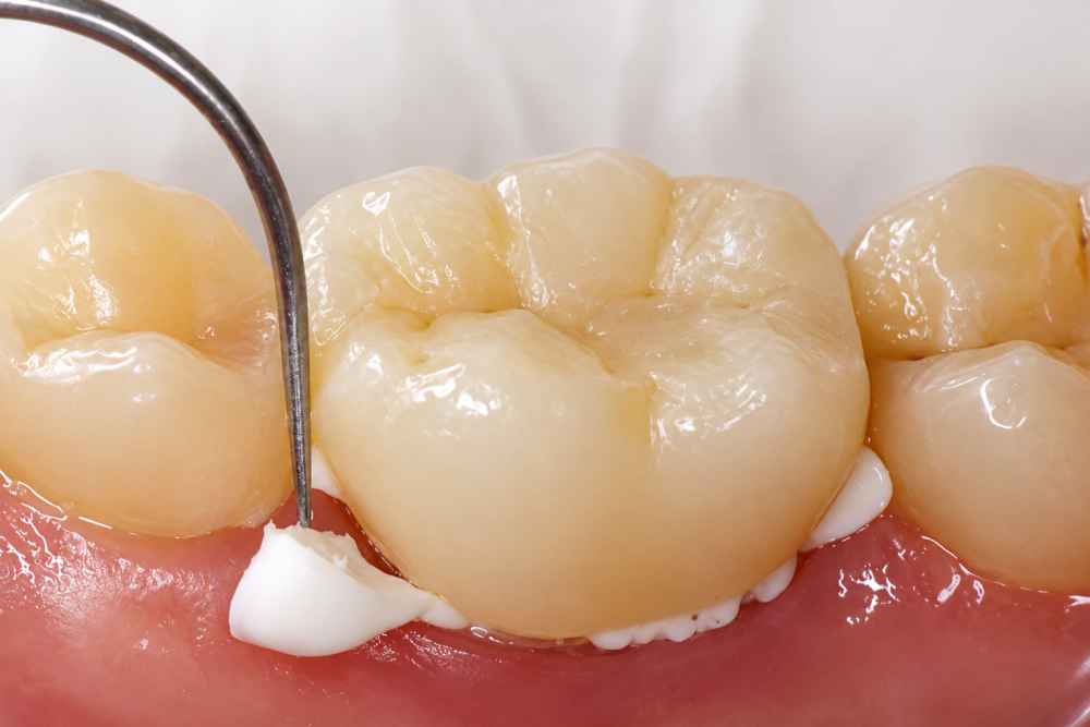Pyrax Glass Ionomer Cement - Lute Type I