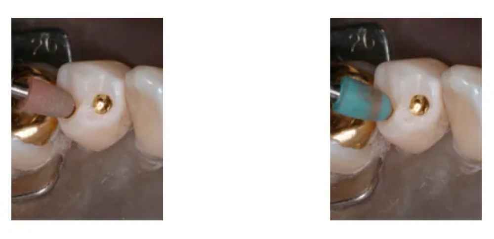 Shofu Gold Polishing Kit Ca/Hp