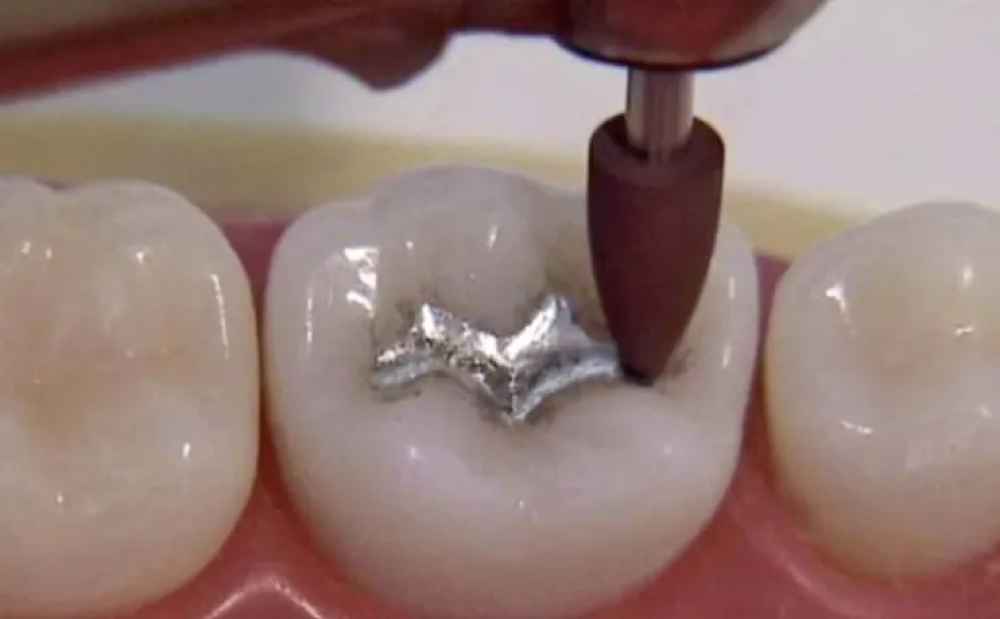 Shofu Amalgam Polishing Kit Fg/Ca