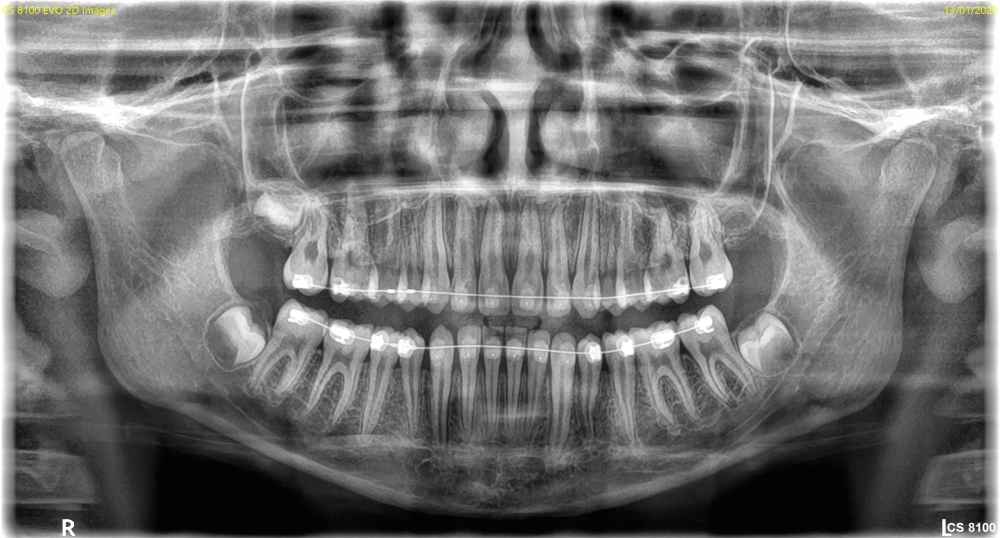 Carestream Dental CS8100 ACCESS OPG