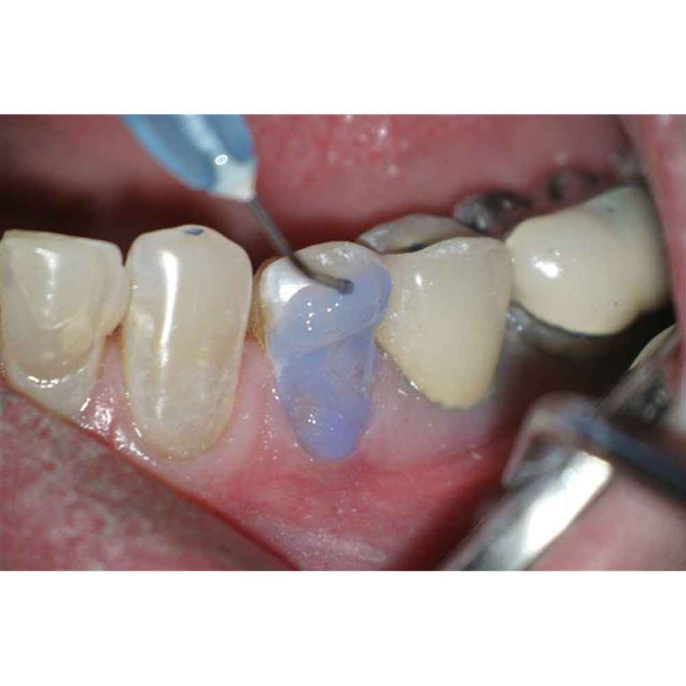 Bisco 32% Uni-Etch with BAC