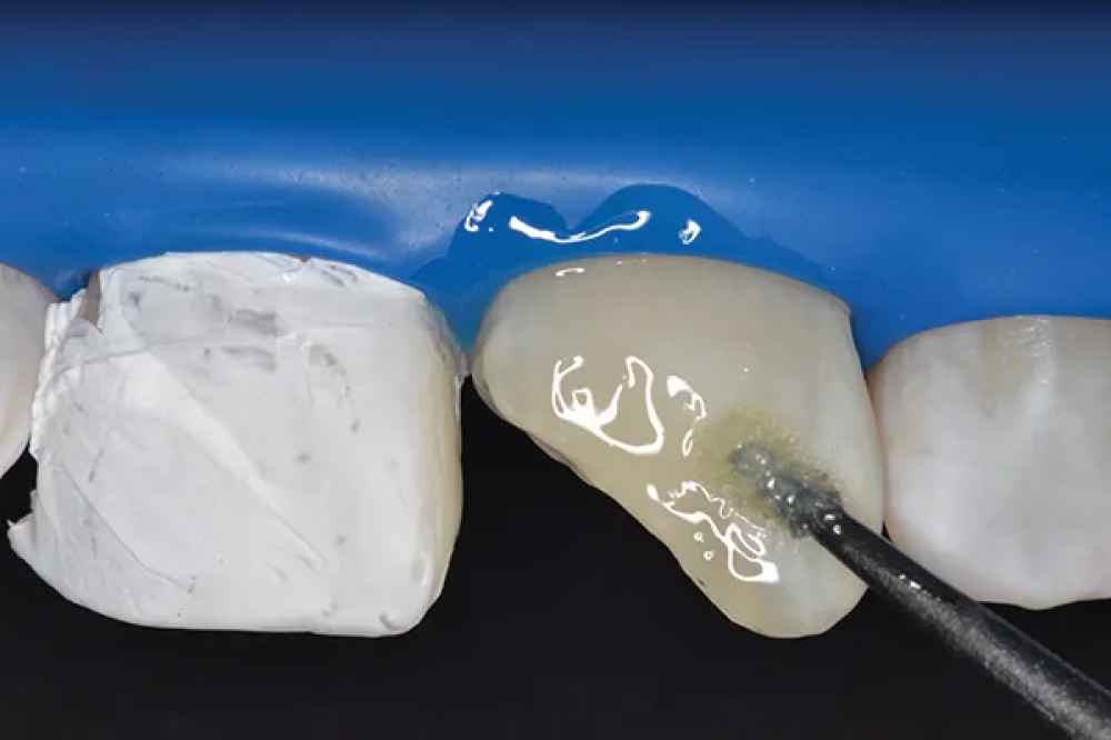 3M ESPE Disposable Applicator Tips