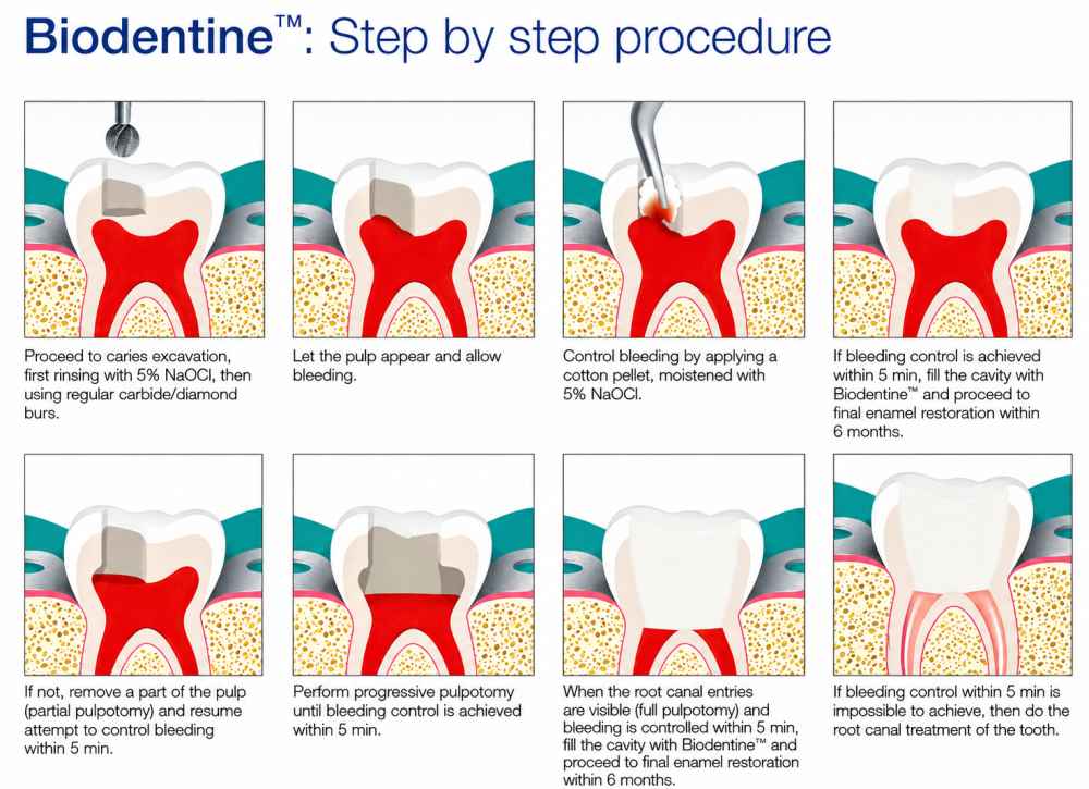 Septodont Biodentine Kit ( Pack of 5 capsules )