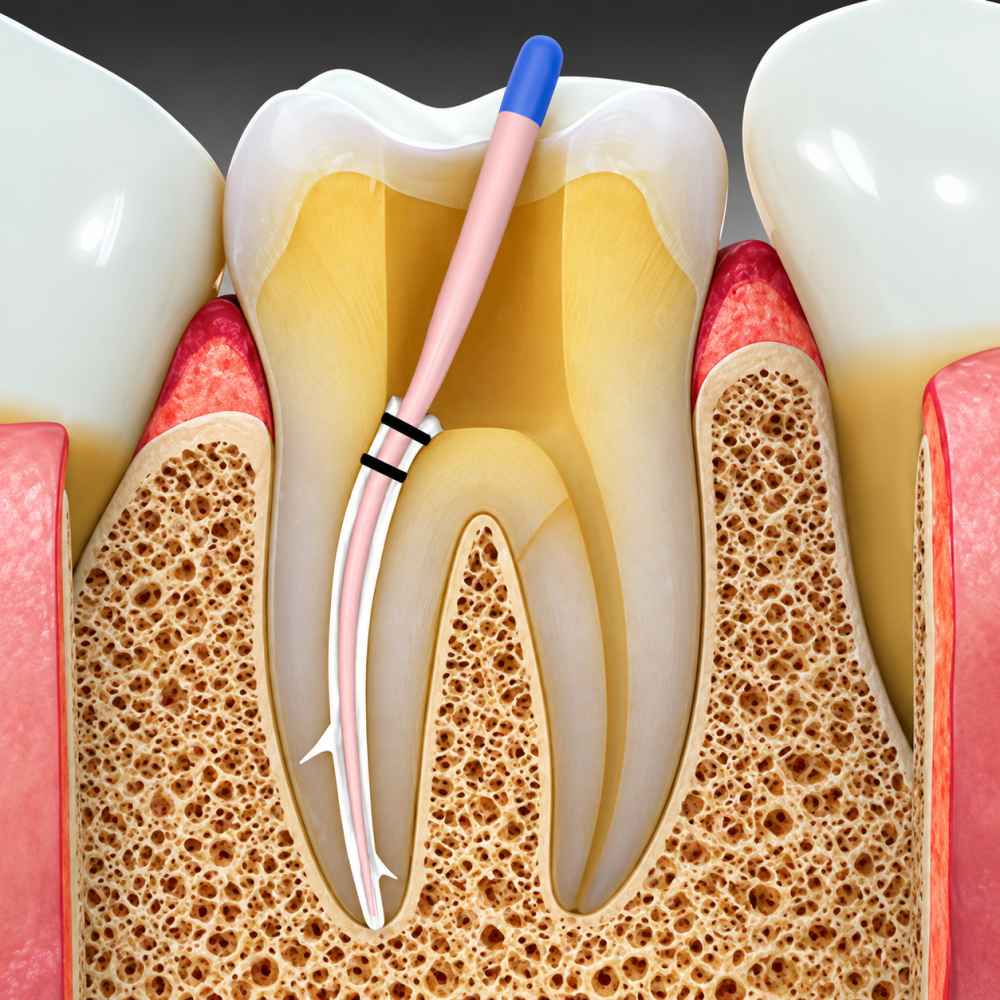 Septodont Bio Root RCS Mineral-based Root Canal Sealer