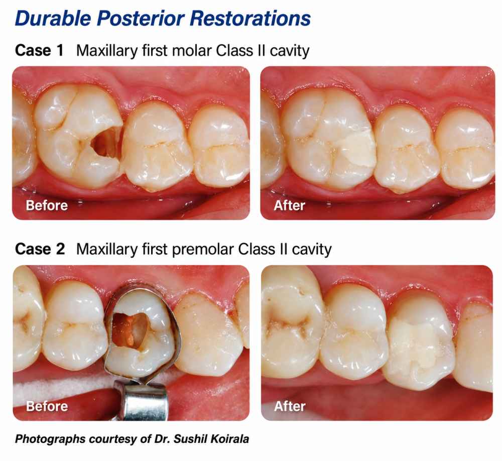 Shofu Zirconomer Improved Reinforced Glass Ionomer