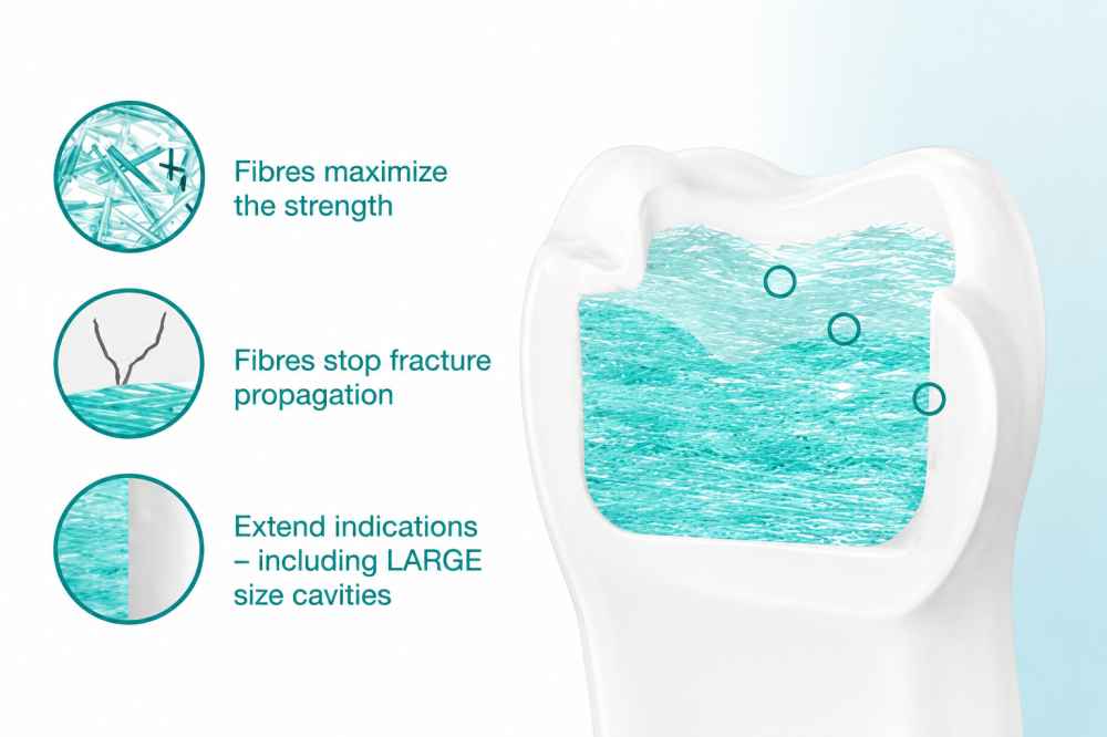 GC Everx Posterior