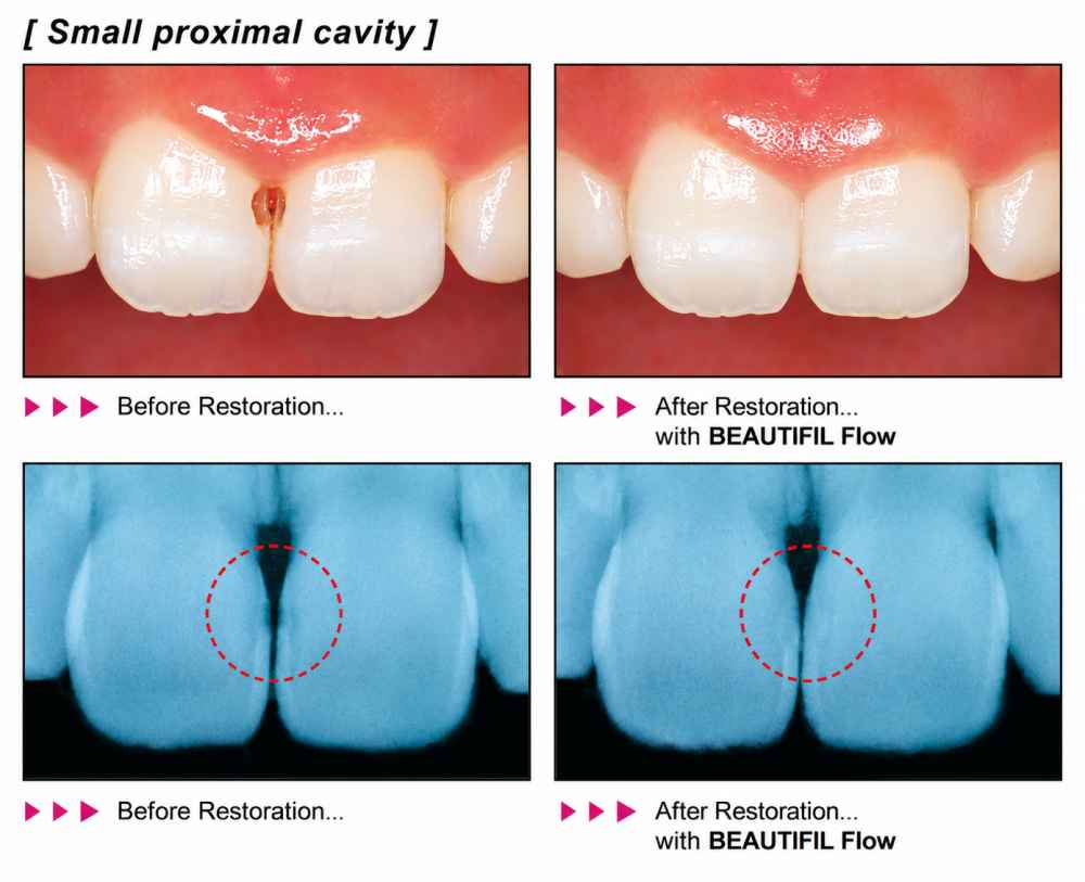 Shofu Beautifil Flow F02 Refill Flowable Composite