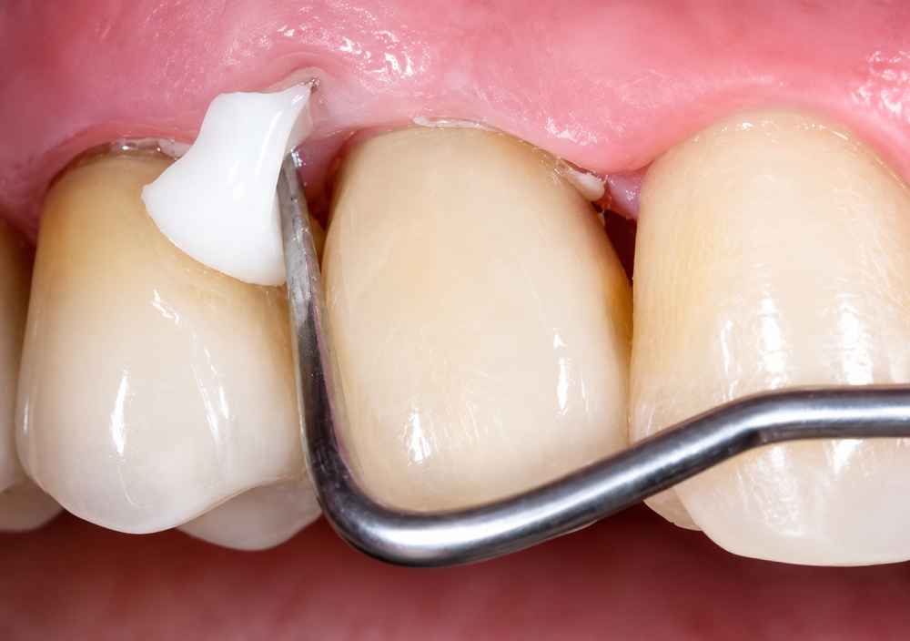 GC Gold Label 1 Luting & Lining Glass Ionomer Cement 