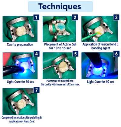 Prevest Fusion Universal Composite 7Syr Kit Prevest Fusion Universal Composite 7Syr Kit