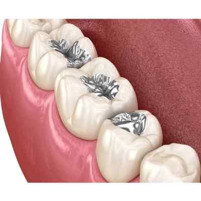 DPI Dental Silver Amalgam Powder 15g DPI Dental Silver Amalgam Powder 15g