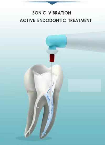 Glin Dental Sonic Endo Irrigator ( 120 Tips )