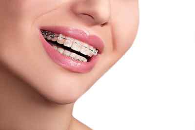 Dental Ceramic Orthodontic Bracket Kit Dental Ceramic Orthodontic Bracket Kit