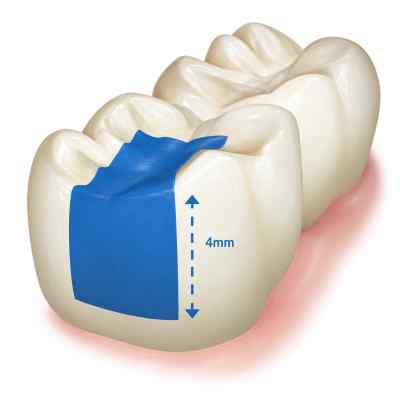 Wizdent Wonder Bulk Fill #Universal Shade 4g