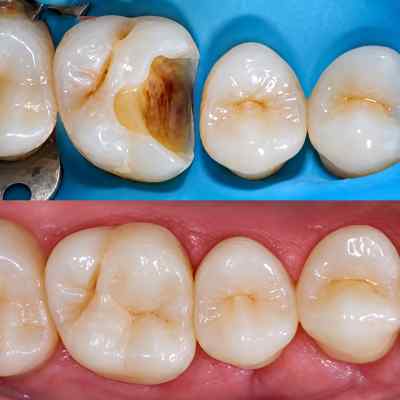 Wizdent Wonder Bulk Fill #Universal Shade 4g
