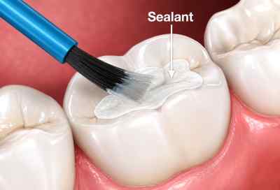 SDI Conseal F Pit & Fissure Sealant SDI Conseal F Pit & Fissure Sealant