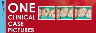 Kulzer Topaz One Shade Resin Based Restorative Composite Kit Kulzer Topaz One Shade Resin Based Restorative Composite Kit