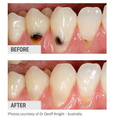SDI Riva Light Cure Powder & Liquid Kit Glass Ionomer Cement SDI Riva Light Cure Powder & Liquid Kit Glass Ionomer Cement