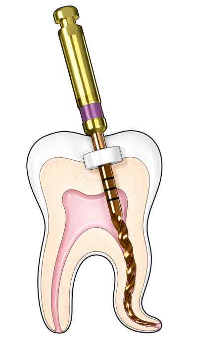 Woodpecker Endo Plus Heat Treated Gold Rotary File Woodpecker Endo Plus Heat Treated Gold Rotary File
