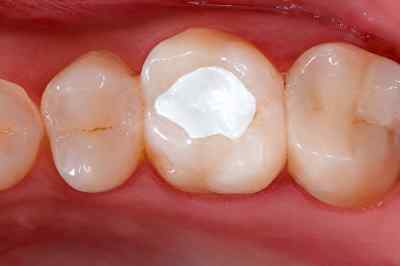 Septodont Cimpat Rose