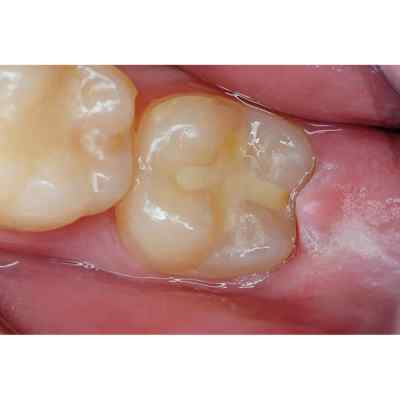 Spident BaGIC ll Glass Ionomer Filling Material Spident BaGIC ll Glass Ionomer Filling Material