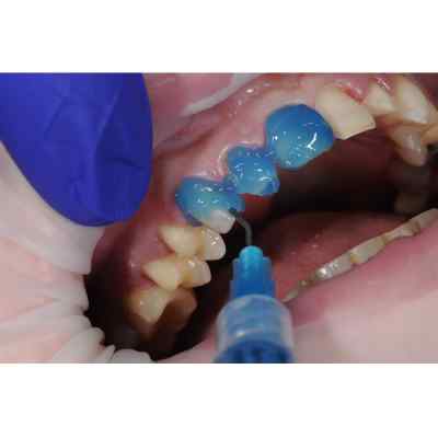 Spident FineEtch 37 Etching Gel Syringe Spident FineEtch 37 Etching Gel Syringe