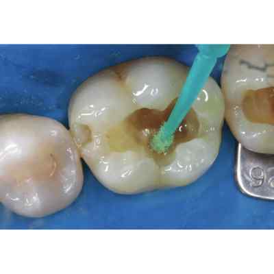 Spident EsBond 5th Generation Bonding Agent Spident EsBond 5th Generation Bonding Agent