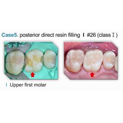 Spident EsCom250 NanoHybrid Composite Spident EsCom250 NanoHybrid Composite