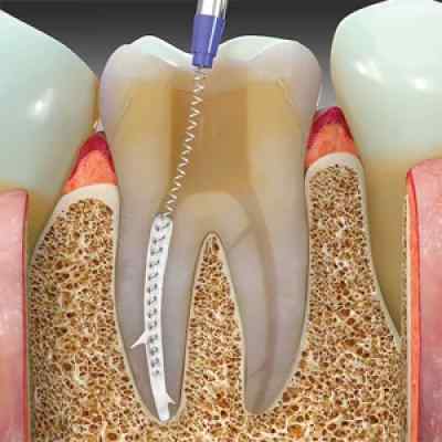 Maarc Sealmax+ MTA based Bio Ceramic root canal sealing material Maarc Sealmax+ MTA based Bio Ceramic root canal sealing material