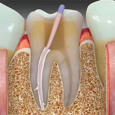 Maarc Sealmax+ MTA based Bio Ceramic root canal sealing material Maarc Sealmax+ MTA based Bio Ceramic root canal sealing material