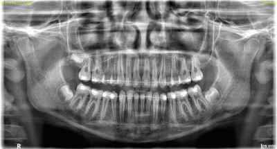 Carestream Dental CS8100 ACCESS OPG