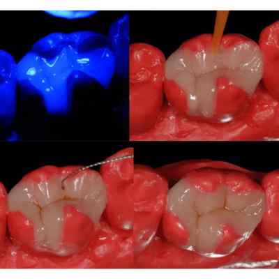 Voco Die Silicone - Cartridge 50 ml Voco Die Silicone - Cartridge 50 ml