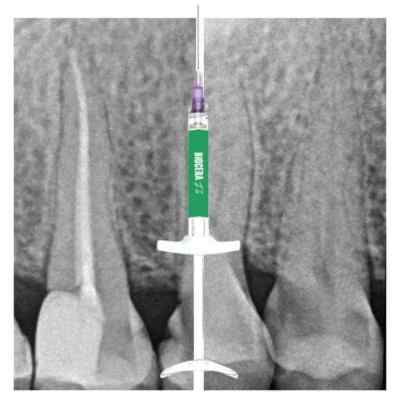 NT Biocera Flo Bioceramic Root Canal Sealer NT Biocera Flo Bioceramic Root Canal Sealer