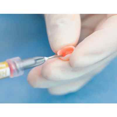 Vincismile HF-Etchant Hydrofluoric Acid Etching Gel Vincismile HF-Etchant Hydrofluoric Acid Etching Gel