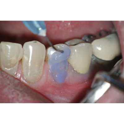 Bisco 32% Uni-Etch with BAC