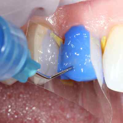 Bisco 32% Uni-Etch with BAC