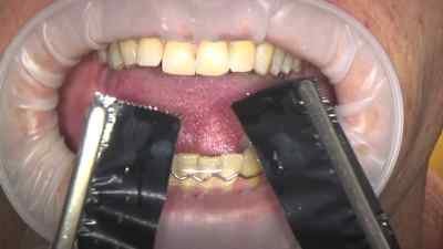 Bausch Dental Arti Fol Metallic Shimstock Flim 12µ Microns Bausch Dental Arti Fol Metallic Shimstock Flim 12µ Microns