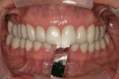 Bausch Dental Arti Fol Metallic Shimstock Flim 12µ Microns Bausch Dental Arti Fol Metallic Shimstock Flim 12µ Microns