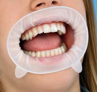 Ivoclar Optragate Cheek And Lip Retractor Ivoclar Optragate Cheek And Lip Retractor