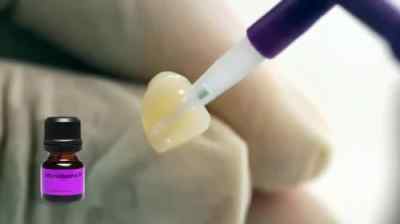 Ivoclar Monobond N 5gm Universal, single-component bonding agent