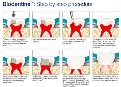 Septodont Biodentine Kit ( Pack of 5 capsules )