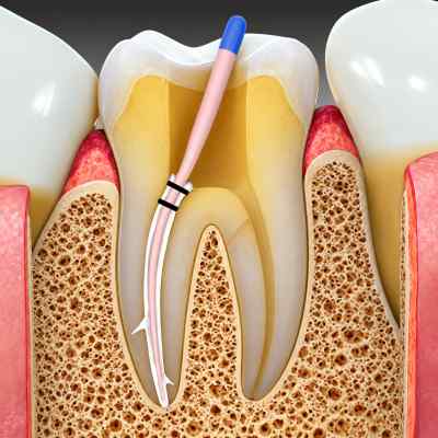 Septodont Bio Root RCS Mineral-based Root Canal Sealer