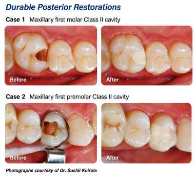 Shofu Zirconomer Improved Reinforced Glass Ionomer Shofu Zirconomer Improved Reinforced Glass Ionomer
